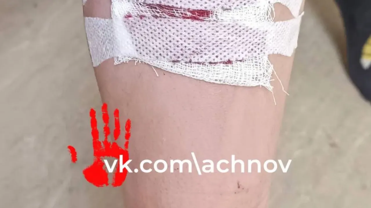 В Аргаяше ребенку после укуса бродячей собаки выплатили 100 тысяч рублей — Челябинск Сейчас