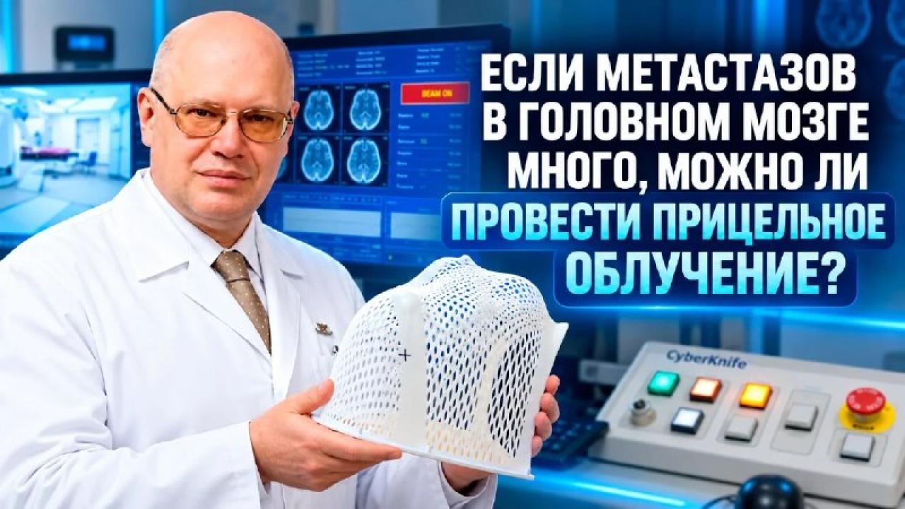 В НМИЦ радиологии изучают адаптивную лучевую терапию при метастазах в головном мозге — Настоящий Обнинск