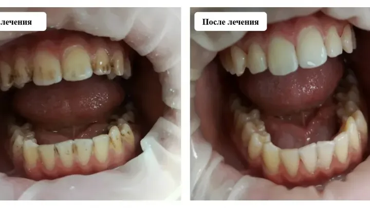 Воронежские стоматологи удалили у 12-летнего пациента стойкий налёт на зубах — Воронеж Сейчас